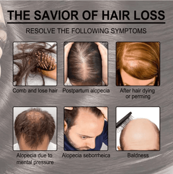 Rosemary Oil for Hair Growth UAE – 100% Pure & Natural